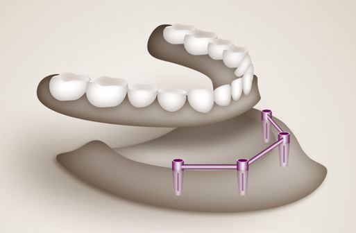 PEEK DENTAL DISC